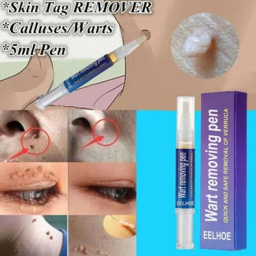 Wart Removal Pen