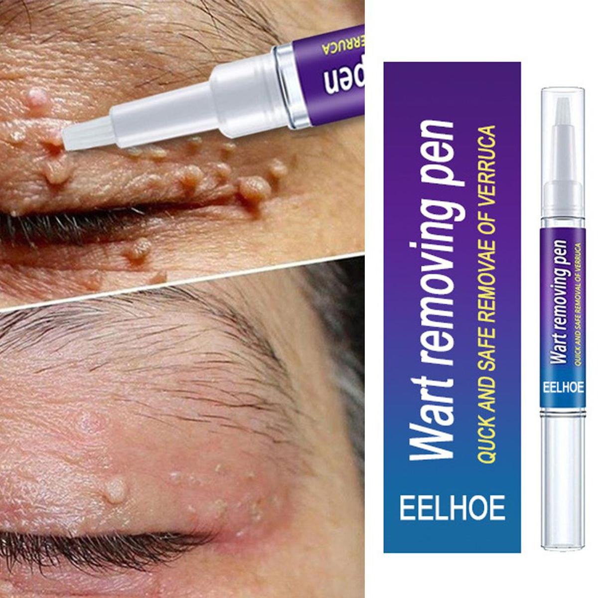 Wart Removal Pen