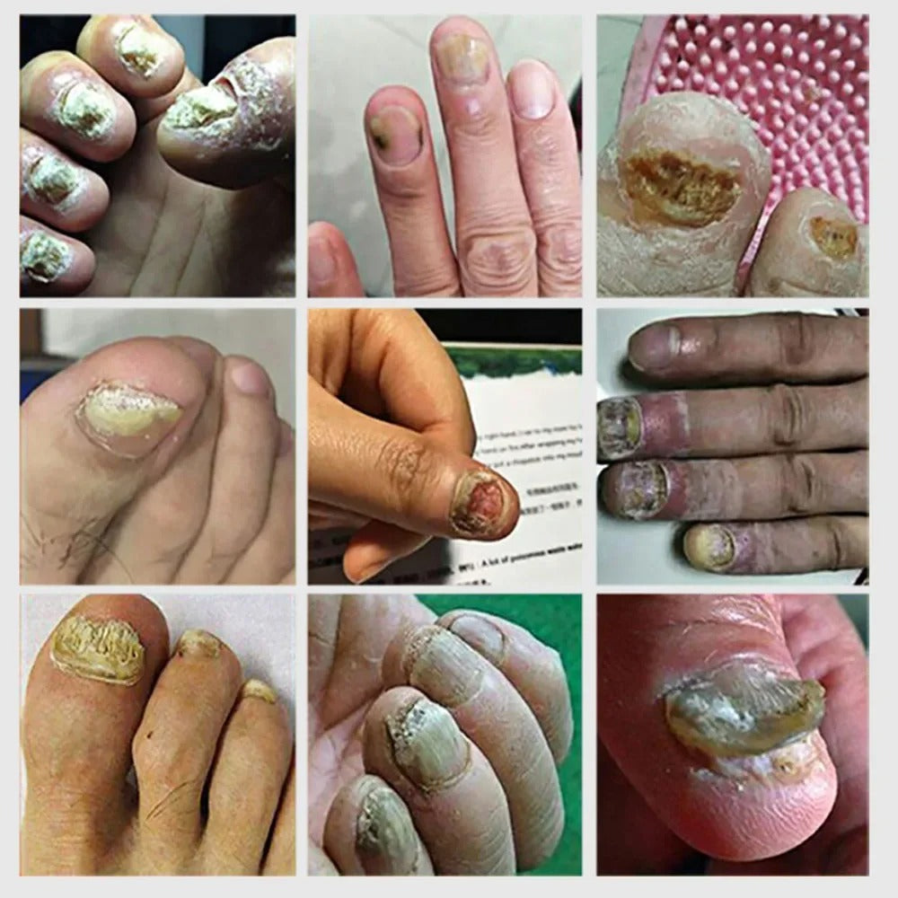 Nail Fungus Serum ( Made In USA )