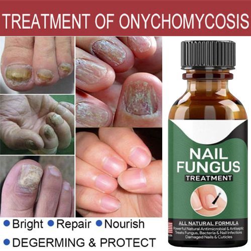 Nail Fungus Serum ( Made In USA )